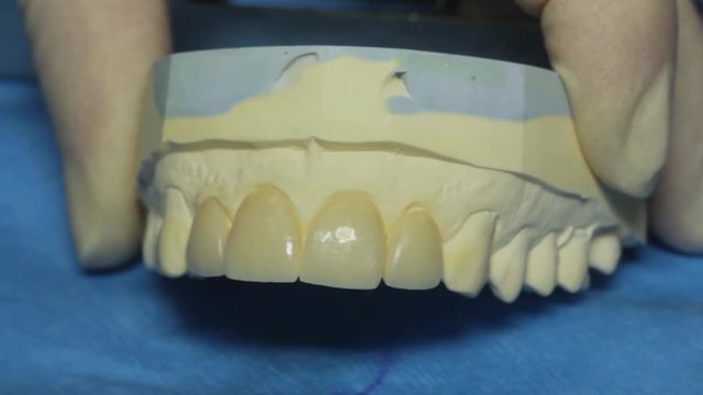 Dental Cast Jaws, Dentures, Dental Veneers