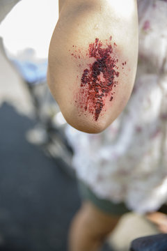 Cropped view of girls arm with grazed elbow, focus on foreground