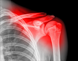 X-ray of human painful shoulder on back background