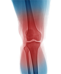 Right pain knee joint X-ray photos, the front position