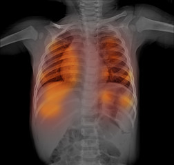 Children chest X-rays , lung