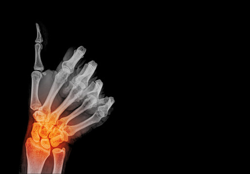 pain human hand x-ray - Medical Image , good sing