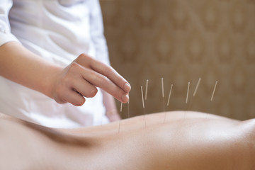 needle acupuncture procedure;