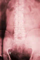 Hip joint surgical implant xray scan