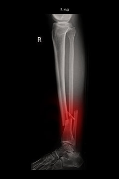 fracture left leg tibia and fibula