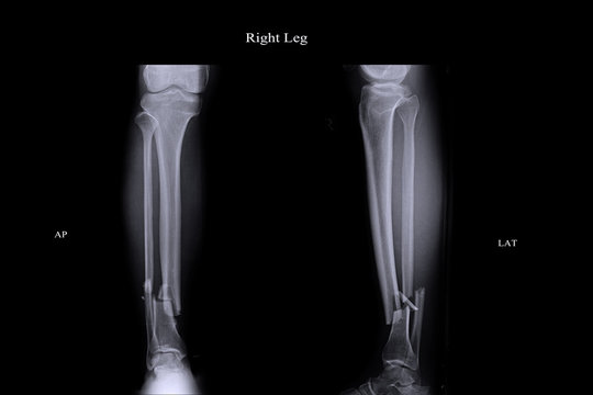 closed fracture left leg tibia and fibula