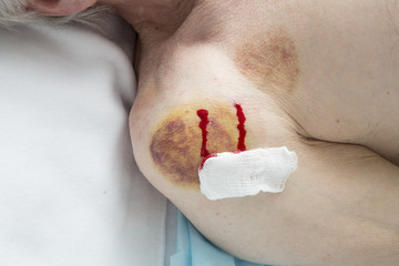 Multiple vacuum cup of medical cupping therapy on human body