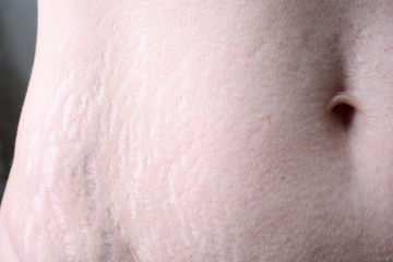 Female belly with stretch marks