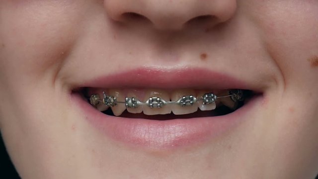Close up of braces on teeth. Girl showing braces on teeth.