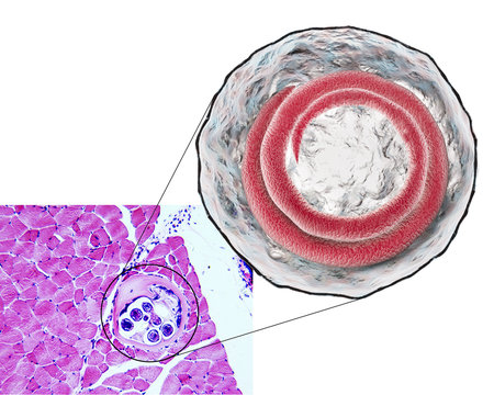 3D illustration and microphotograph (transverse section) of cyst in muscle containing heminth Trichinella spiralis, nematode larval cyst in muscle tissue, transmitted by ingestion of undercooked meat