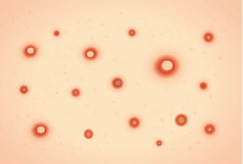 Itchy rash and red spots or blisters from chickenpox on patient skin. This illustration about medical.