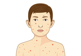 Child get chickenpox disease. He has an itchy rash and red spots or blisters.
