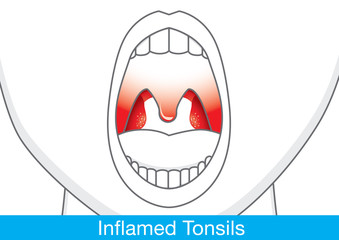 Showing Inflamed tonsils by open mouth. This illustration about health and medical.