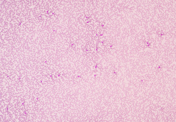Neutrophilia is leukocytosis of neutrophils, that is, a high num