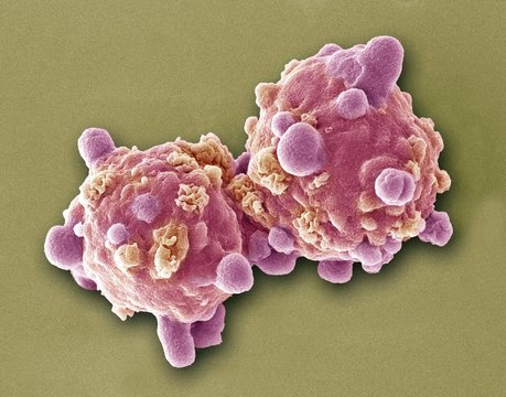 Leukaemia cells, SEM