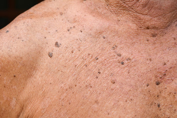 Fototapeta premium Moles on the body