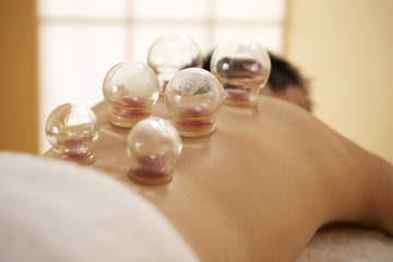 Cupping