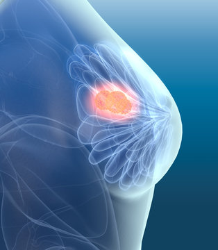 Breast cancer, mastocarcinoma, artwork