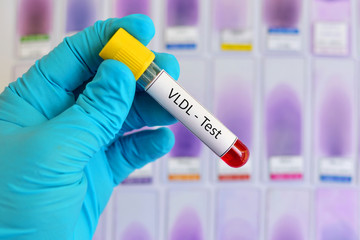 Blood sample for VLDL (Very low-density lipoprotein cholesterol) test
