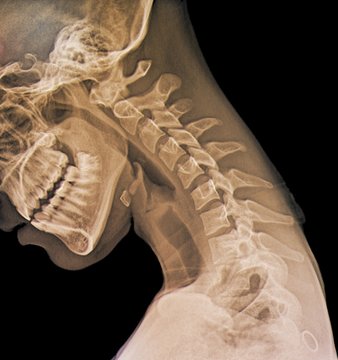 Normal flexed neck, X-ray
