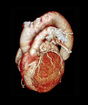 Normal Heart, 3D CT Scan