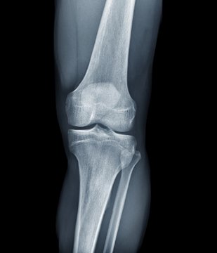Normal knee, X-rays