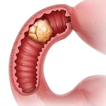 Small intestine with tumor, illustration