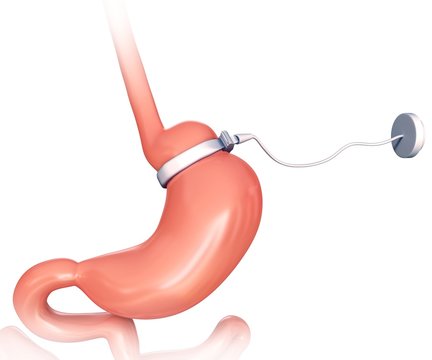 Human Gastric Band, Illustration