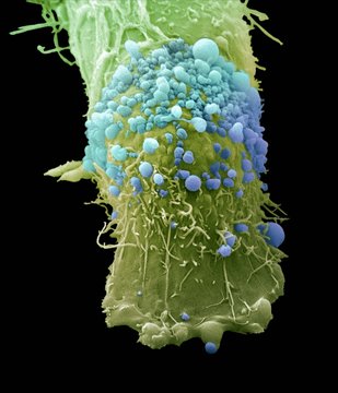 Skin cancer cell, SEM