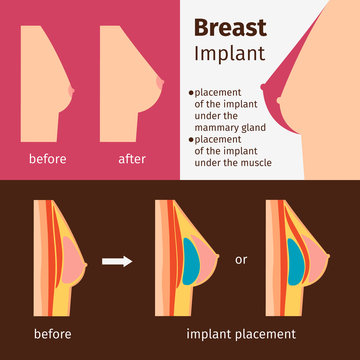 Breast augmentation infographics. Breast implants vector illustration