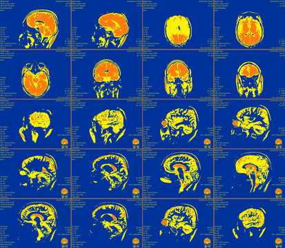 Magnetic resonance imaging of the brain 