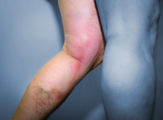 Thrombophlebitis in human leg