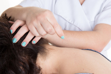 Acupuncture needles on neck of a young woman at the spa