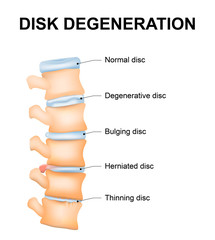 Disc degeneration - obrazy, fototapety, plakaty