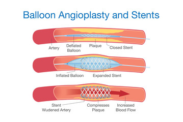 Balloon angioplasty and stents procedure for heart disease treatment. This illustration about medical.