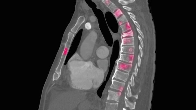 Metastatic lesions to spine