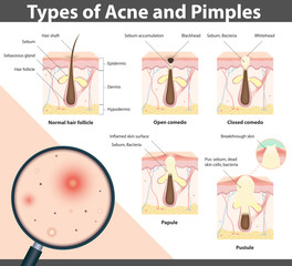 Obraz premium Types of Acne and Pimples, vector illustration