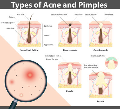 Types of Acne and Pimples, vector illustration
