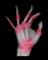 Human hand x-ray - Medical Image.