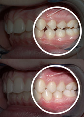after and before orthodontic treatment