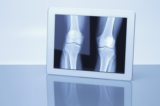 Digital tablet displaying X-ray image of knees