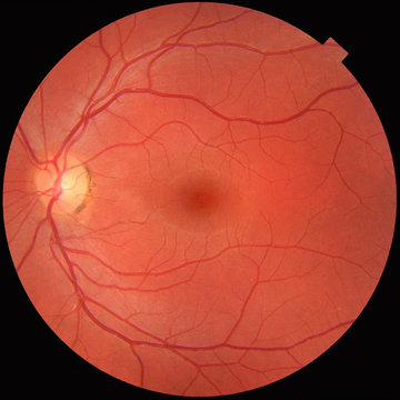 Fundus photograph of a normal left eye. Macula in center and optic disk where blood vessels converge with pigmentation on perimeter