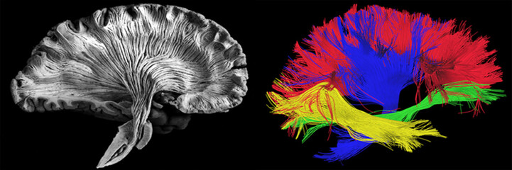 Sagittal, side view. Left - picture of a human brain dissection by a neuroanatomist, Right - reconstructed fibers by tractography