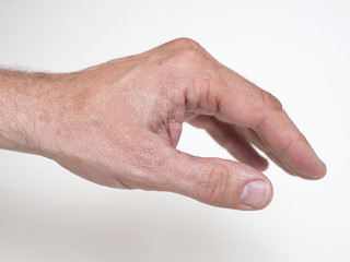 Neurodermitis, linke Handfl&auml;che 084 nach Cortisonbehandlung und nat&uuml;rlichem Pflegemittel