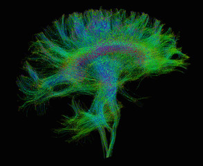 Diffusion MRI, also referred to as diffusion tensor imaging or DTI, of the human brain