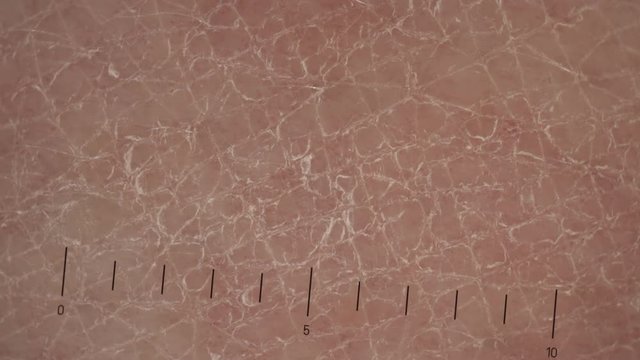 Dry human skin under dermatoscope