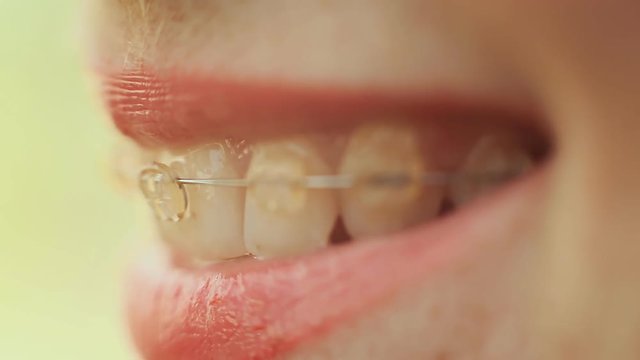 The girl with braces smiling Macro Shooting.