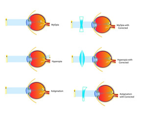 Astigmatism, Myopia and Hyperopia