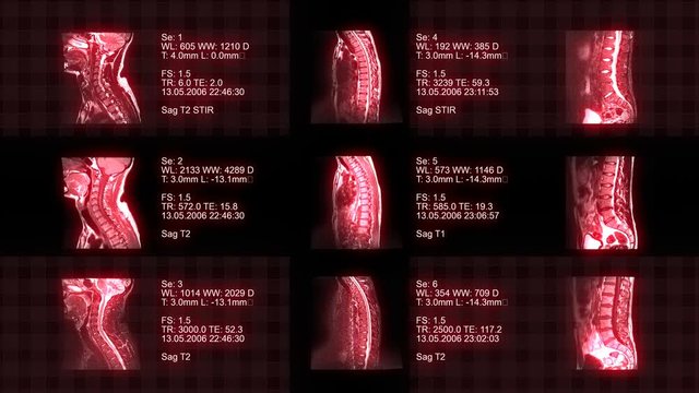 4k set of spine MRI, real animated tomography of the spine, Magnetic resonance imaging.