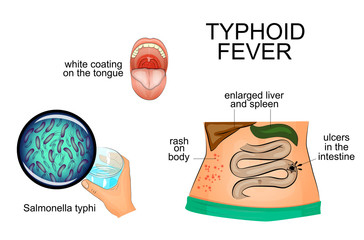 typhoid fever. infographics. pathogen.